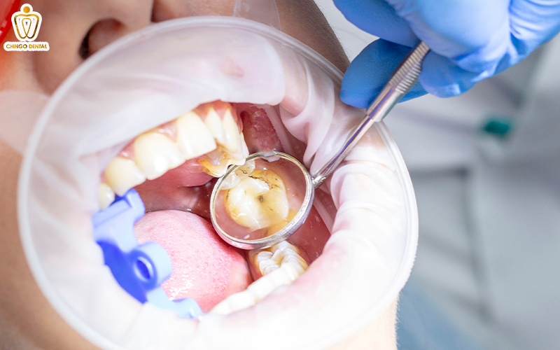 Trám Răng Sâu: Giải Pháp Phục Hồi Răng Thật Toàn Diện 5 trám răng rồi có bị sâu lại không