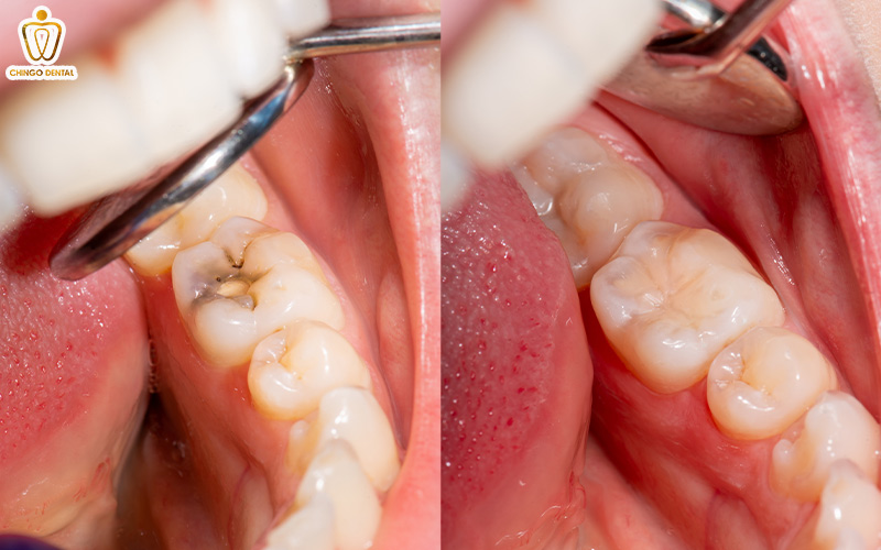 Trám Răng Sâu: Giải Pháp Phục Hồi Răng Thật Toàn Diện 6 trám răng sâu bao nhiêu tiền