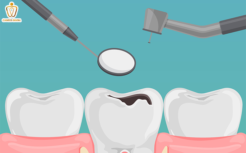 Trám Răng Sâu: Giải Pháp Phục Hồi Răng Thật Toàn Diện 3 trám răng sâu lỗ to bao nhiêu tiền