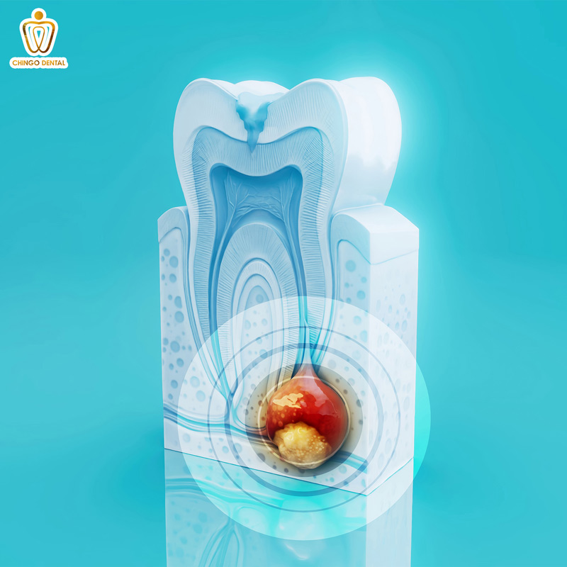 Nang Thân Răng Là Gì? Biến Chứng Tiêu Xương và Nguy Cơ Tái Phát Đáng Lo Ngại 5 u nang răng là gì