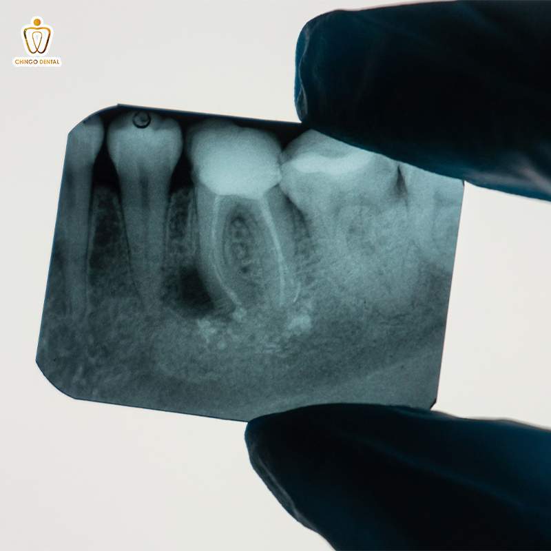 viêm quanh chóp răng cấp tính