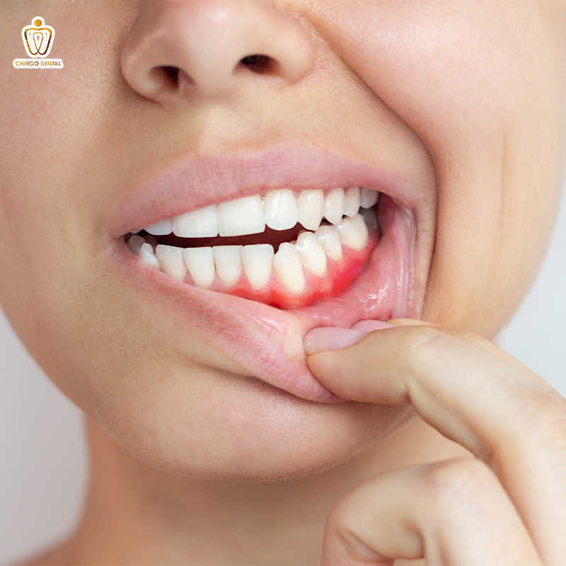 viêm quanh chóp răng