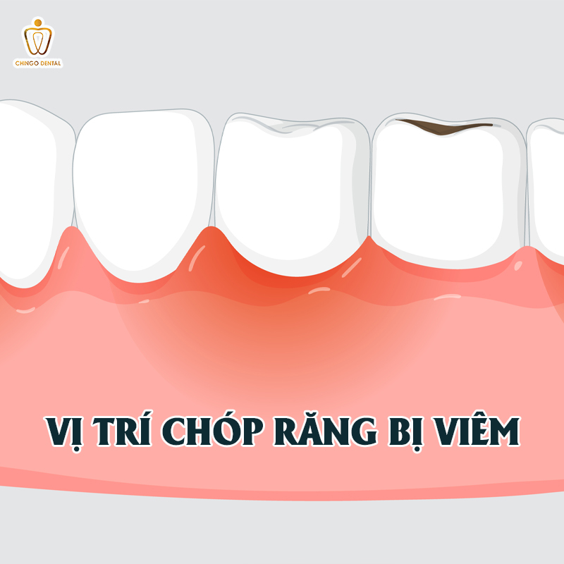 viêm quanh cuống răng