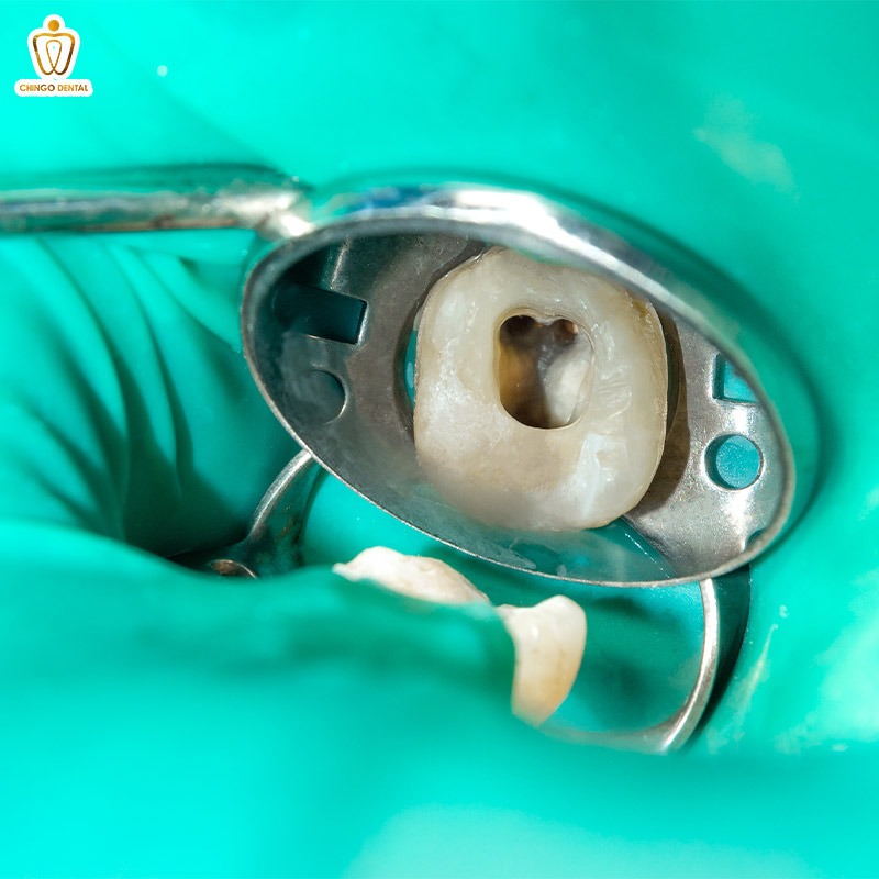 Các Mức Độ Sâu Răng: Nhận Biết, Nguyên Nhân và Cách Điều Trị Hiệu Quả 4 các mức độ của sâu răng