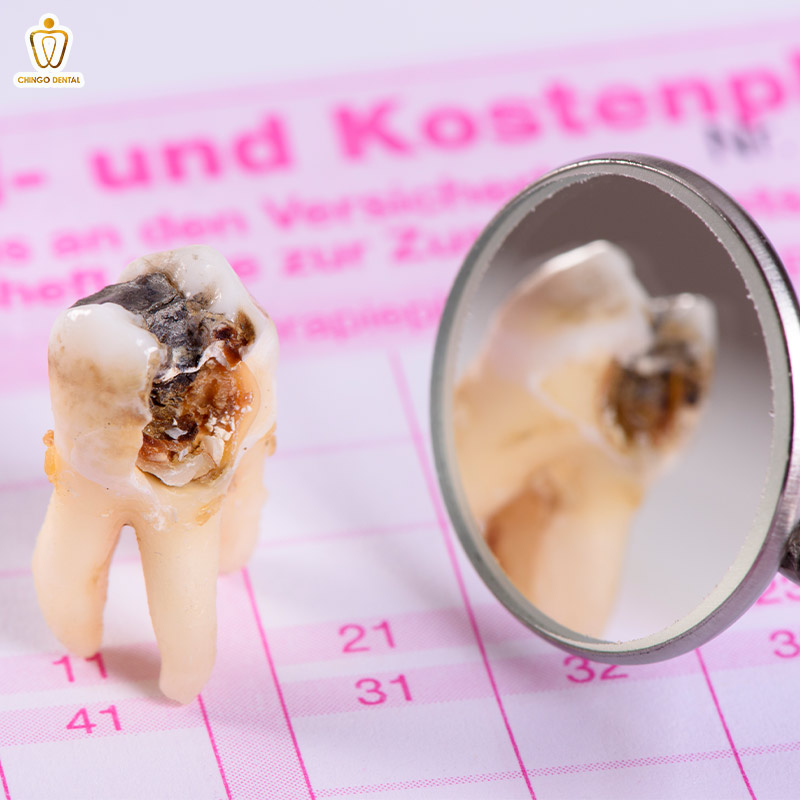 Các Mức Độ Sâu Răng: Nhận Biết, Nguyên Nhân và Cách Điều Trị Hiệu Quả 2 các mức độ sâu răng