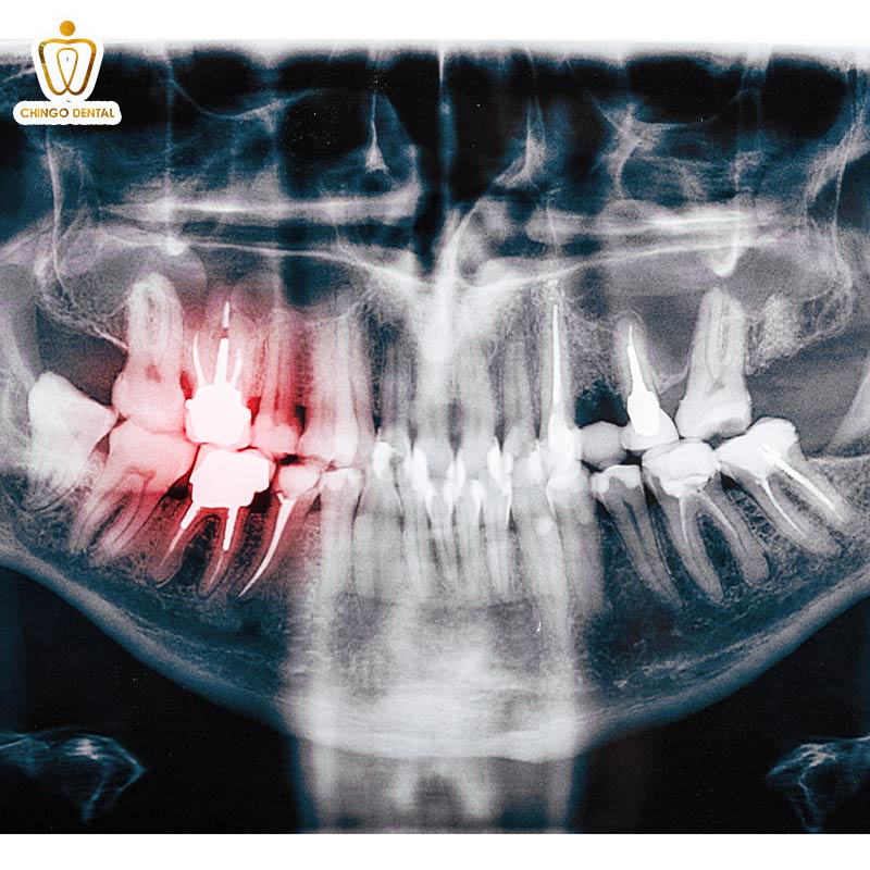 Chụp X-quang Răng: Chìa Khóa Vàng Cho Nụ Cười Khỏe Mạnh Từ Gốc 4 chụp phim răng