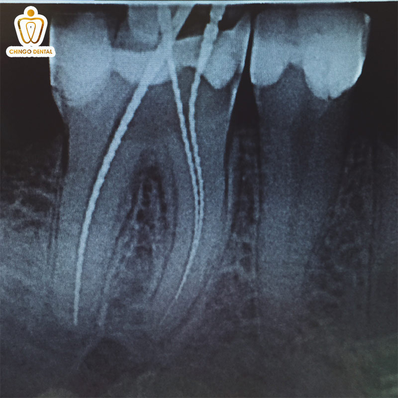 Chụp X-quang Răng: Chìa Khóa Vàng Cho Nụ Cười Khỏe Mạnh Từ Gốc 3 chụp x-quang răng hết bao nhiêu tiền