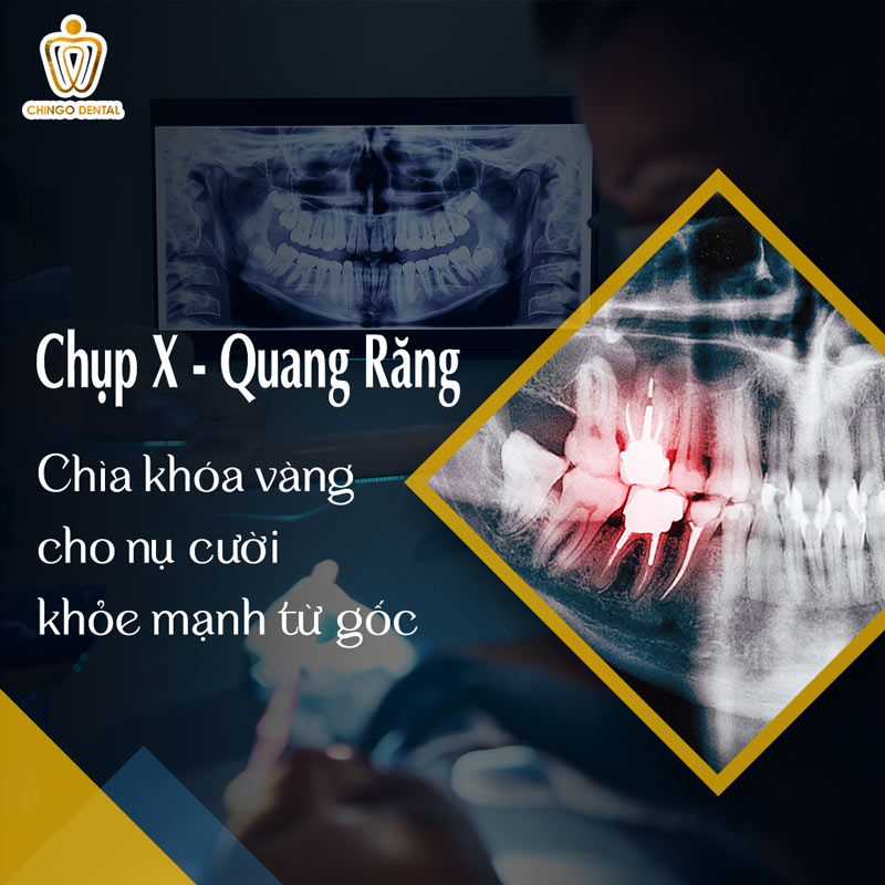 Chụp X-quang Răng: Chìa Khóa Vàng Cho Nụ Cười Khỏe Mạnh Từ Gốc 6 chụp x-quang răng