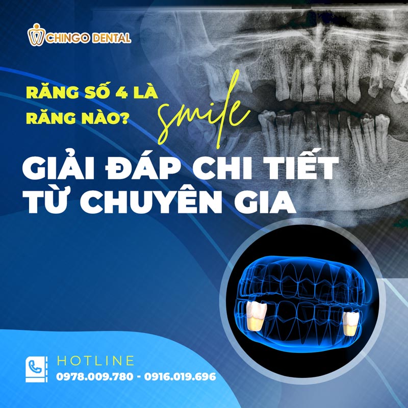 Răng Số 4 Là Răng Nào? Có Nên Nhổ Để Niềng Không? - Những Lưu Ý "Sống Còn" Bạn Cần Biết 5 có nên nhổ răng số 4 để niềng không