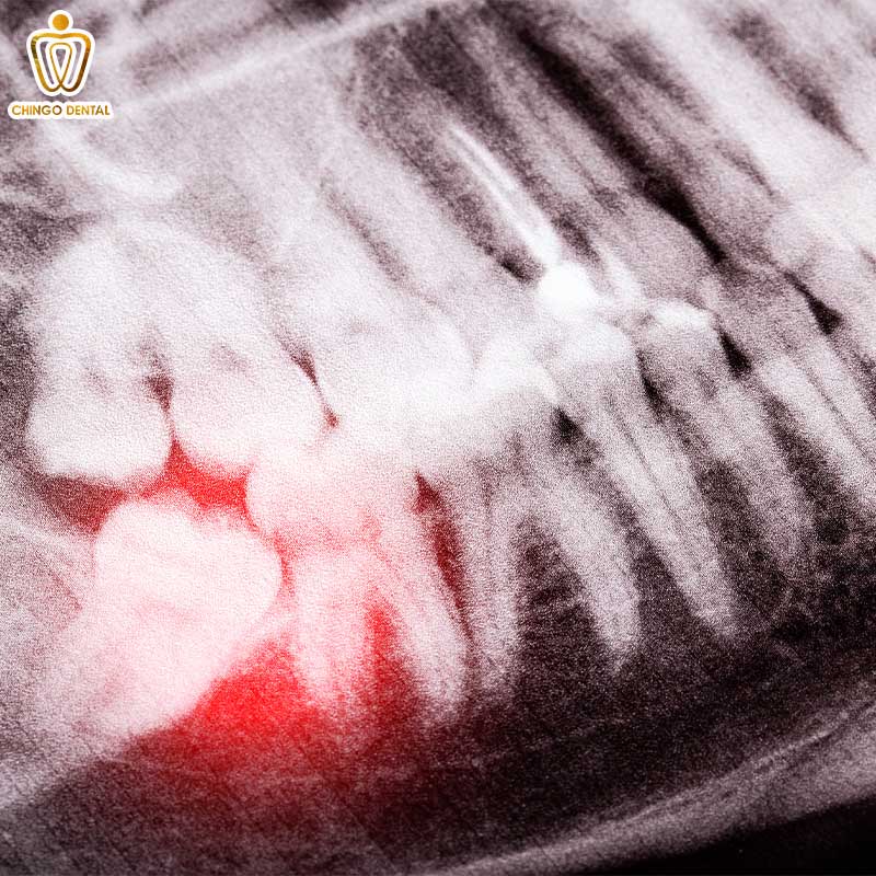 Đau Răng Hàm Đeo Bám? Hiểu Đúng Nguyên Nhân Và Khám Phá Giải Pháp Điều Trị Tận Gốc 3 dấu hiệu mọc răng khôn hàm dưới