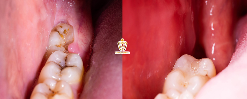 Đau Răng Hàm Đeo Bám? Hiểu Đúng Nguyên Nhân Và Khám Phá Giải Pháp Điều Trị Tận Gốc 2 đau răng hàm gây đau đầu