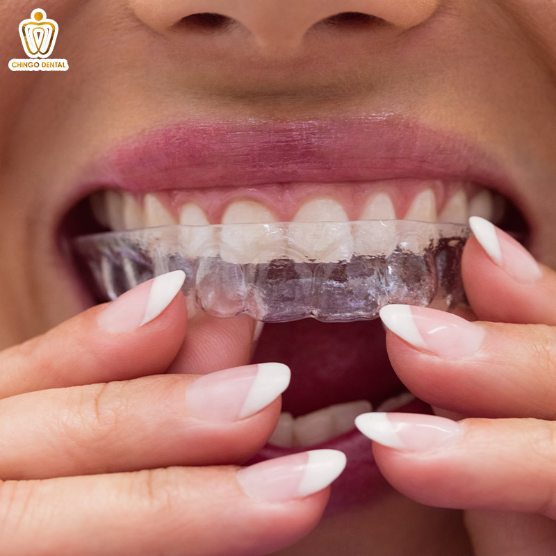 Niềng Răng Invisalign 3 giá niềng răng invisalign