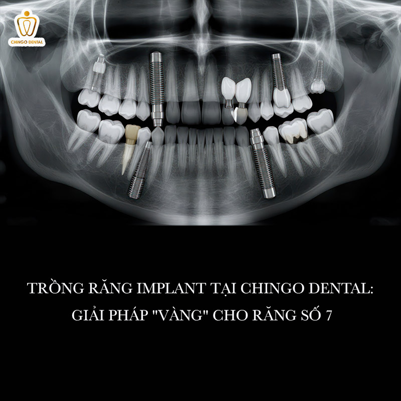 Răng Số 7 Là Răng Nào? Tại Sao Mất Răng Số 7 Được Coi Là "Thảm Họa" Cho Sức Khỏe? 4 nhổ răng số 7 có nguy hiểm không