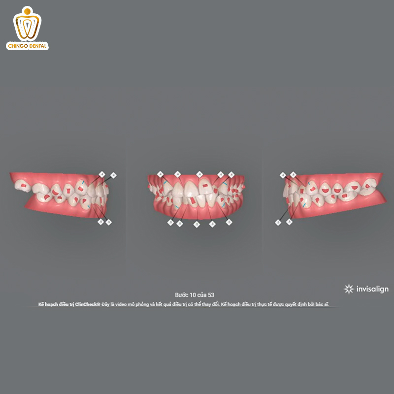 Niềng Răng Invisalign 2 niềng răng invisalign có hiệu quả không