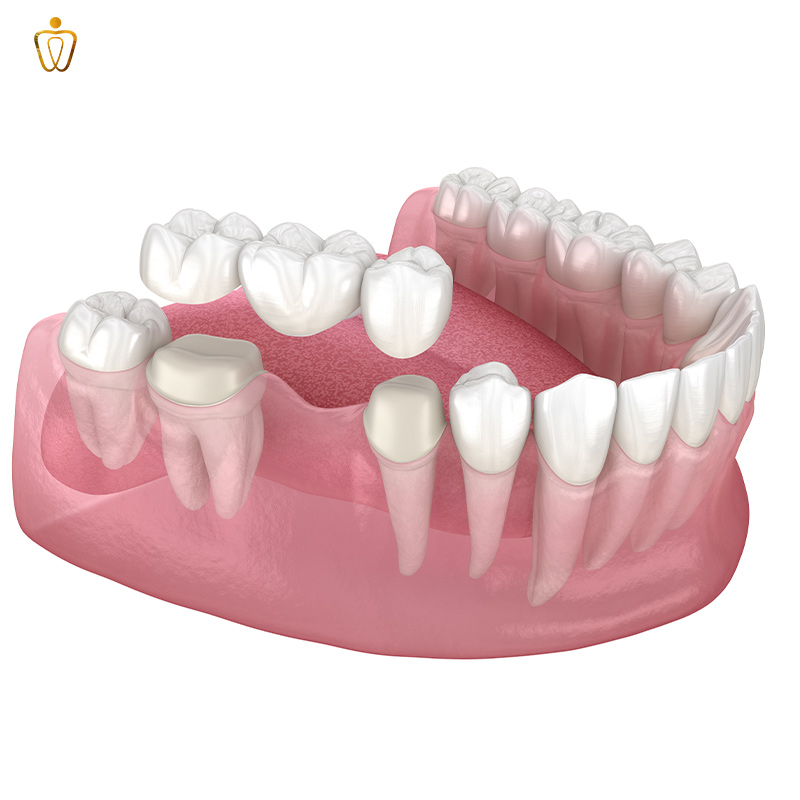 Phục Hình Răng: Giải Pháp Toàn Diện Cho Nụ Cười Và Sức Khỏe Bền Vững 6 phục hình răng là gì