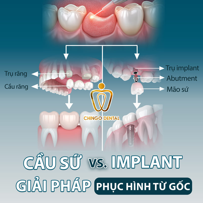 Phục Hình Răng: Giải Pháp Toàn Diện Cho Nụ Cười Và Sức Khỏe Bền Vững 7 phục hình răng sứ bao nhiêu tiền