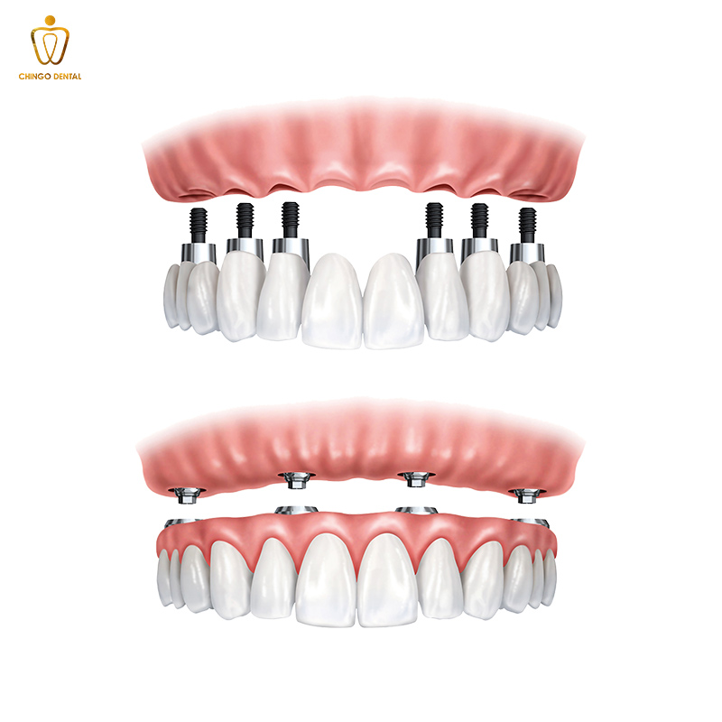 Phục Hình Răng: Giải Pháp Toàn Diện Cho Nụ Cười Và Sức Khỏe Bền Vững 5 phục hình răng sứ trên implant