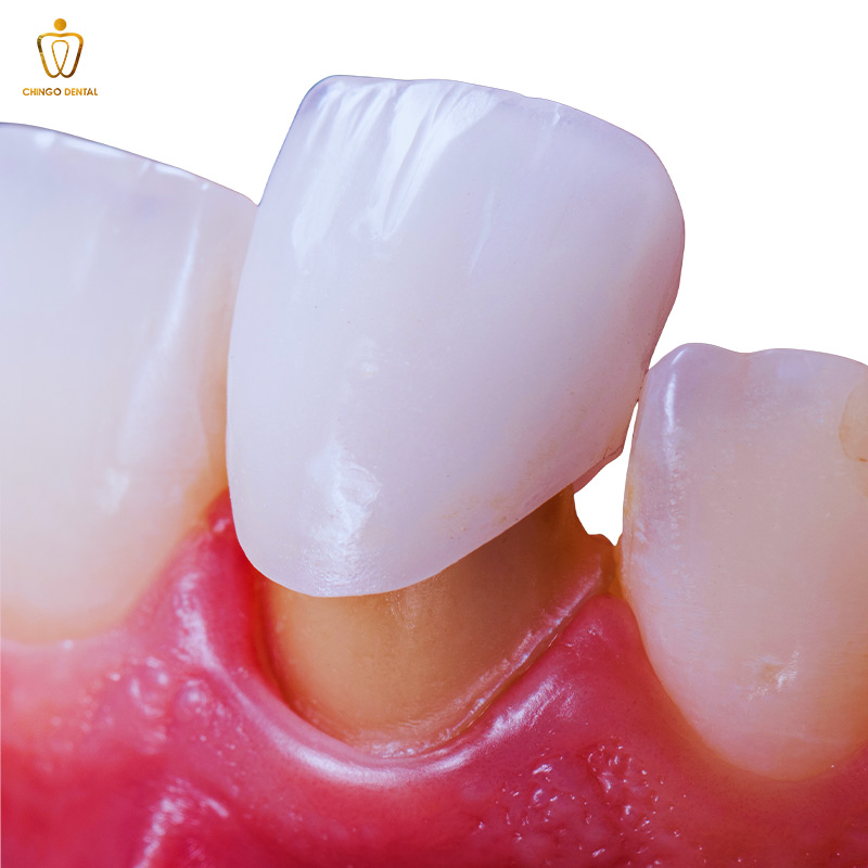 Phục Hình Răng: Giải Pháp Toàn Diện Cho Nụ Cười Và Sức Khỏe Bền Vững 3 phục hình răng sứ