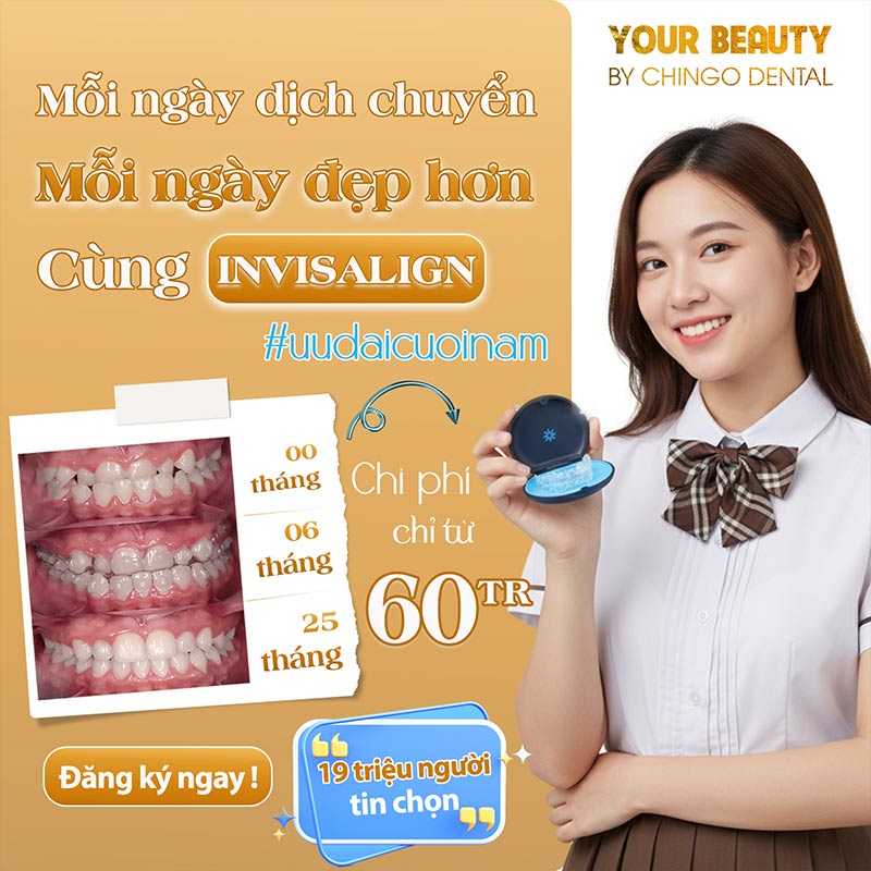 Niềng Răng Invisalign 1 quy trình niềng răng invisalign