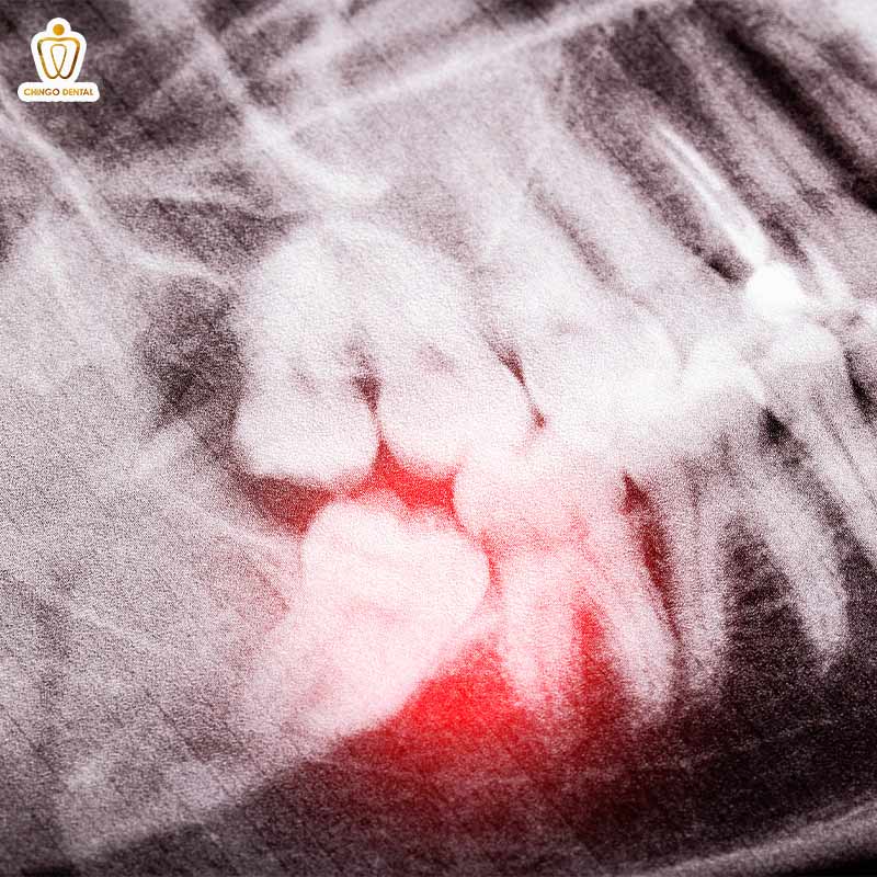 Răng Số 7 Là Răng Nào? Tại Sao Mất Răng Số 7 Được Coi Là "Thảm Họa" Cho Sức Khỏe? 2 răng khôn mọc lệch đâm vào răng số 7