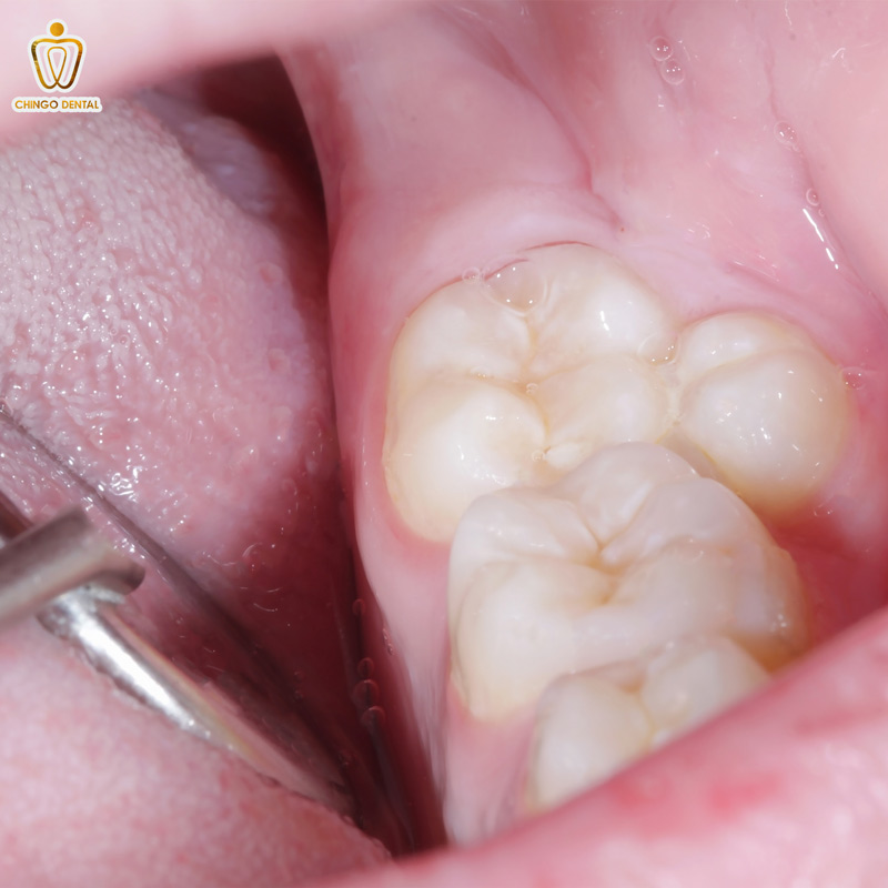 răng mọc thừa phía trong hàm trên