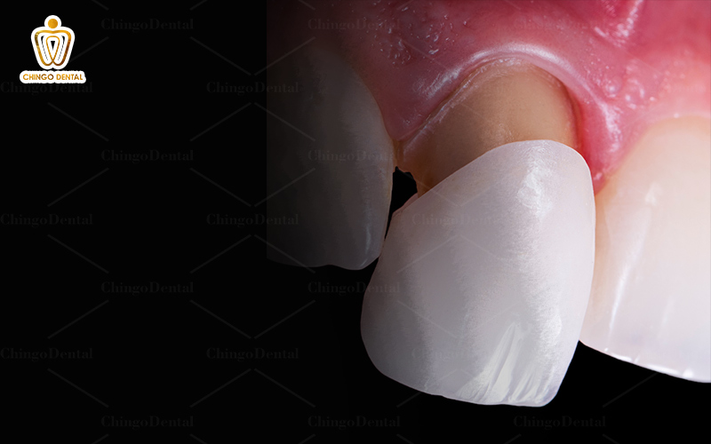 răng nhiễm kháng sinh có tẩy được không
