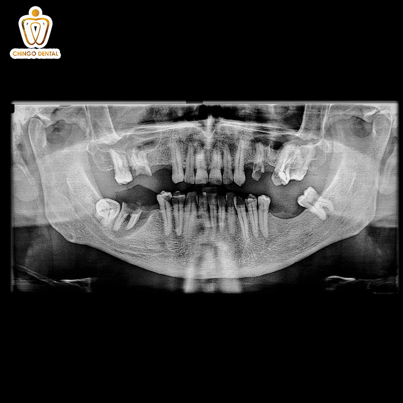 Răng Số 4 Là Răng Nào? Có Nên Nhổ Để Niềng Không? - Những Lưu Ý "Sống Còn" Bạn Cần Biết 2 răng số 4 là răng nào