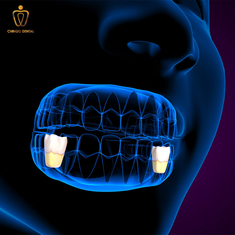 Răng Số 4 Là Răng Nào? Có Nên Nhổ Để Niềng Không? - Những Lưu Ý "Sống Còn" Bạn Cần Biết 1 răng số 4