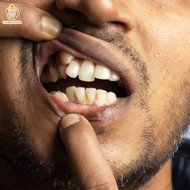 răng thừa là gì