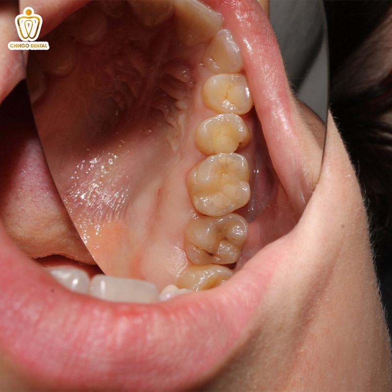 Men Răng Là Gì? "Lớp Áo Giáp" Vô Giá Và Bí Mật Đằng Sau Nụ Cười Bền Vững 4 sâu men răng là gì