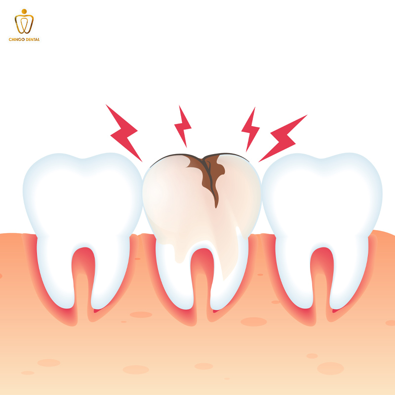 Các Mức Độ Sâu Răng: Nhận Biết, Nguyên Nhân và Cách Điều Trị Hiệu Quả 1 sâu răng mức độ 1