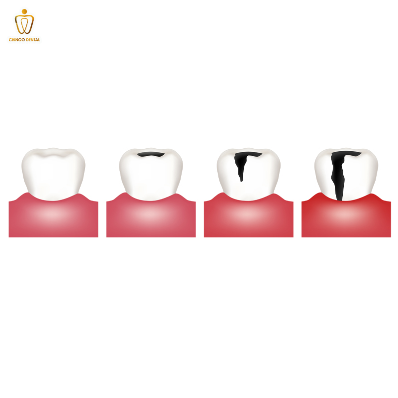 Các Mức Độ Sâu Răng: Nhận Biết, Nguyên Nhân và Cách Điều Trị Hiệu Quả 3 sâu răng mức độ 3