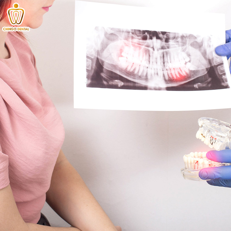 Đau Răng Hàm Đeo Bám? Hiểu Đúng Nguyên Nhân Và Khám Phá Giải Pháp Điều Trị Tận Gốc 4 sưng nướu răng trong cùng hàm dưới đau họng