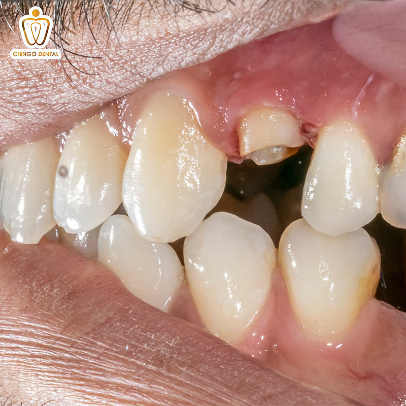 Răng Số 4 Là Răng Nào? Có Nên Nhổ Để Niềng Không? - Những Lưu Ý "Sống Còn" Bạn Cần Biết 3 tác hại của việc nhổ răng số 4