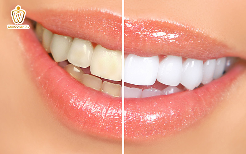 tẩy trắng răng nhiễm kháng sinh
