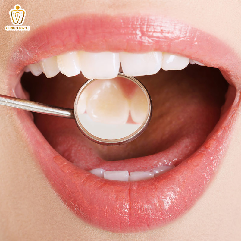 Men Răng Là Gì? "Lớp Áo Giáp" Vô Giá Và Bí Mật Đằng Sau Nụ Cười Bền Vững 5 thiểu sản men răng là gì