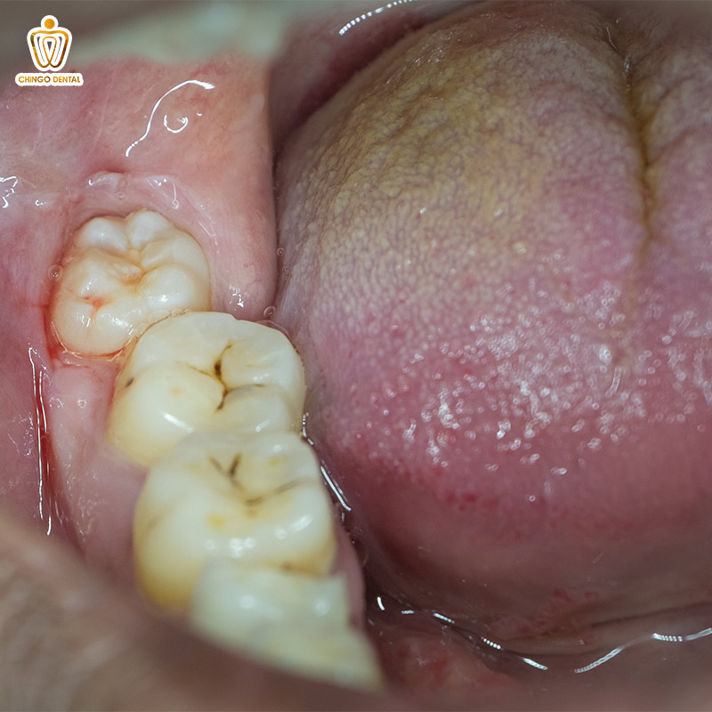 biến chứng sau nhổ răng khôn
