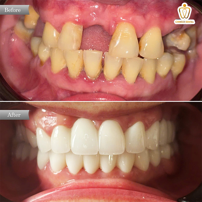 cách làm hết nhức răng vĩnh viễn bằng muối