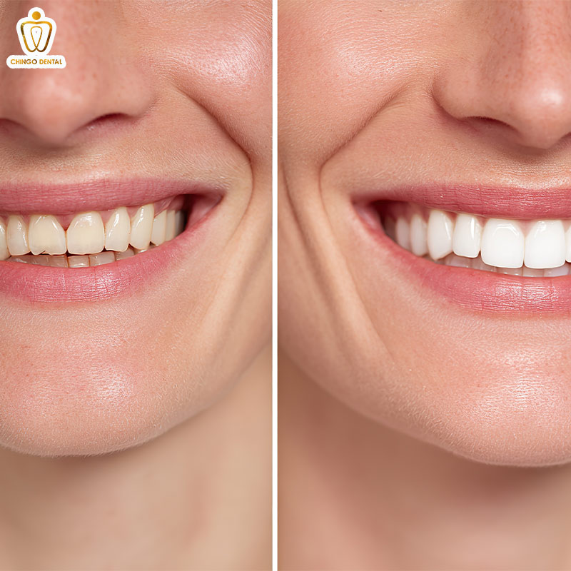 cách làm hết nhức răng vĩnh viễn tại nhà