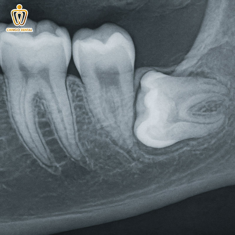 Răng Số 8 Là Răng Gì - Khi Nào Nên Giữ, Khi Nào Cần Nhổ Và Cách Tối Ưu Chi Phí Cho Bạn 1 có nên nhổ răng số 8