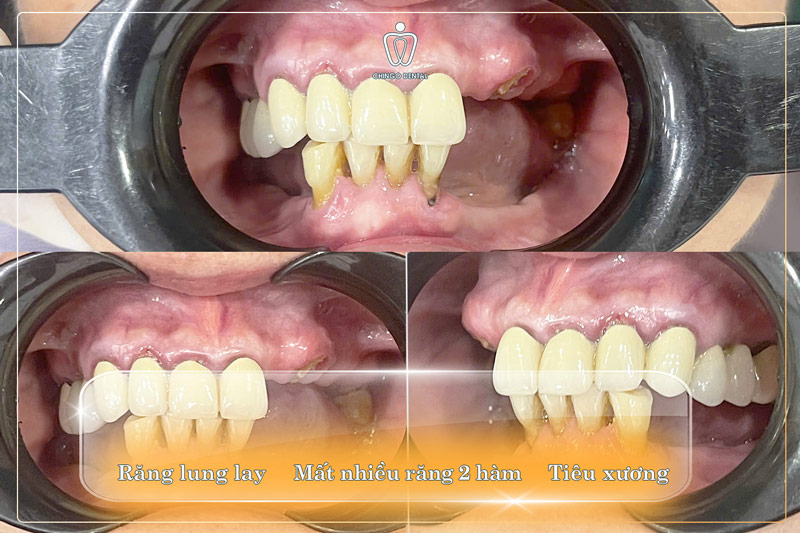 Hạnh Phúc Tìm Lại Sau Những Bữa Cơm "Vắng Vị": Hành Trình Hồi Sinh Nụ Cười Của Cô Trinh 2 đau răng hàm