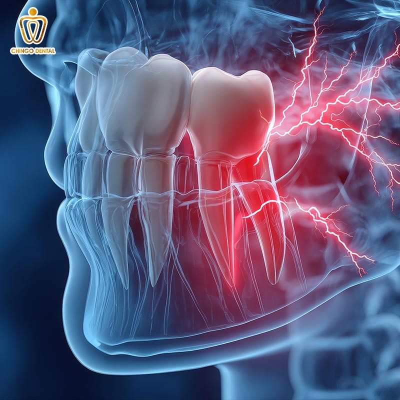 Răng Số 8 Là Răng Gì - Khi Nào Nên Giữ, Khi Nào Cần Nhổ Và Cách Tối Ưu Chi Phí Cho Bạn 4 đau răng số 8