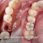 Mất Răng: Cẩm Nang Toàn Diện Về Nguyên Nhân, Hậu Quả Và Giải Pháp Khôi Phục Nụ Cười mất răng lâu năm có trồng implant được không