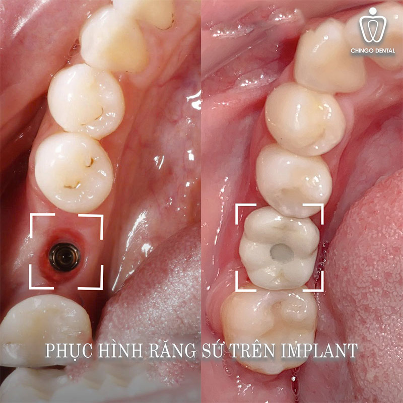 Mất Răng: Cẩm Nang Toàn Diện Về Nguyên Nhân, Hậu Quả Và Giải Pháp Khôi Phục Nụ Cười 4 mất răng lâu năm có trồng implant được không