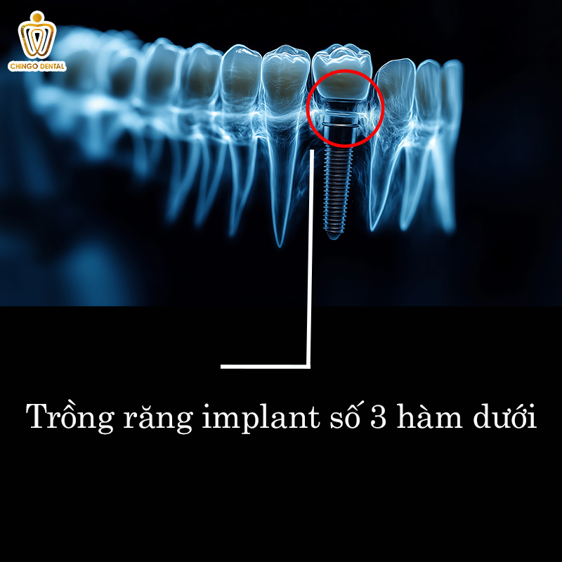 Răng Số 3 Là Răng Nào? Cảnh Báo 6 Hệ Lụy Nguy Hiểm Khi Mất Răng Nanh Mà Bạn Không Nên Xem Thường 1 mất răng số 3 hàm dưới