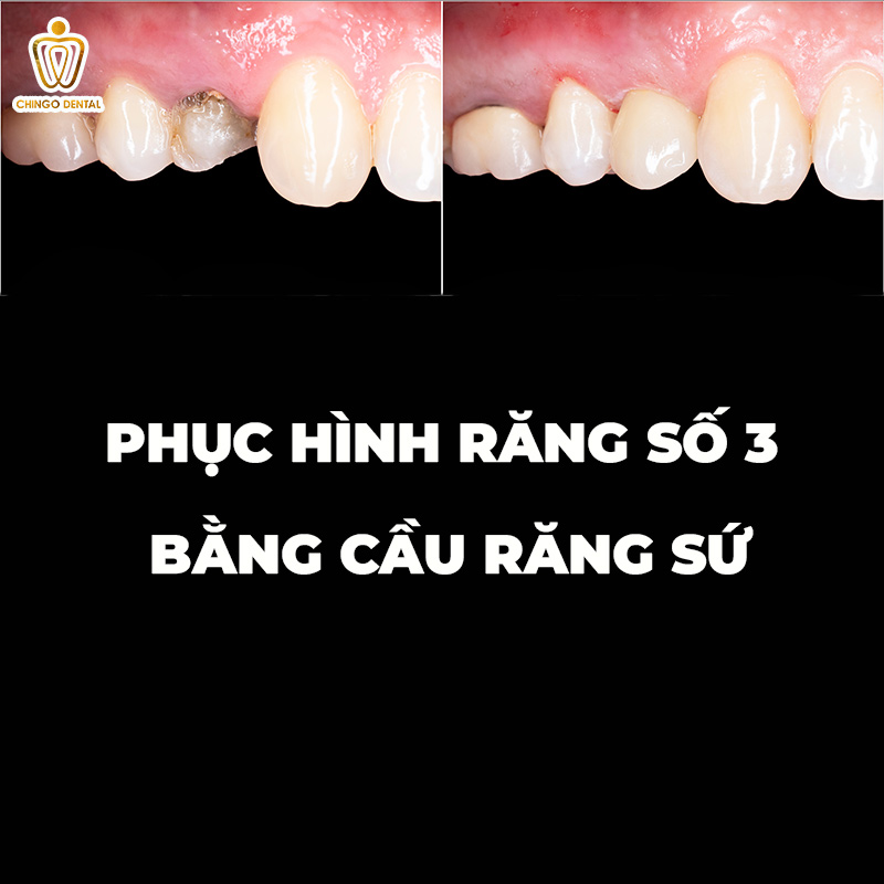 Răng Số 3 Là Răng Nào? Cảnh Báo 6 Hệ Lụy Nguy Hiểm Khi Mất Răng Nanh Mà Bạn Không Nên Xem Thường 4 mất răng số 3 hàm trên
