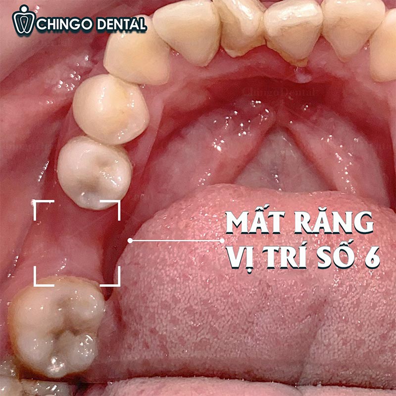Mất Răng: Cẩm Nang Toàn Diện Về Nguyên Nhân, Hậu Quả Và Giải Pháp Khôi Phục Nụ Cười 3 mất răng số 6 hàm dưới có sao không