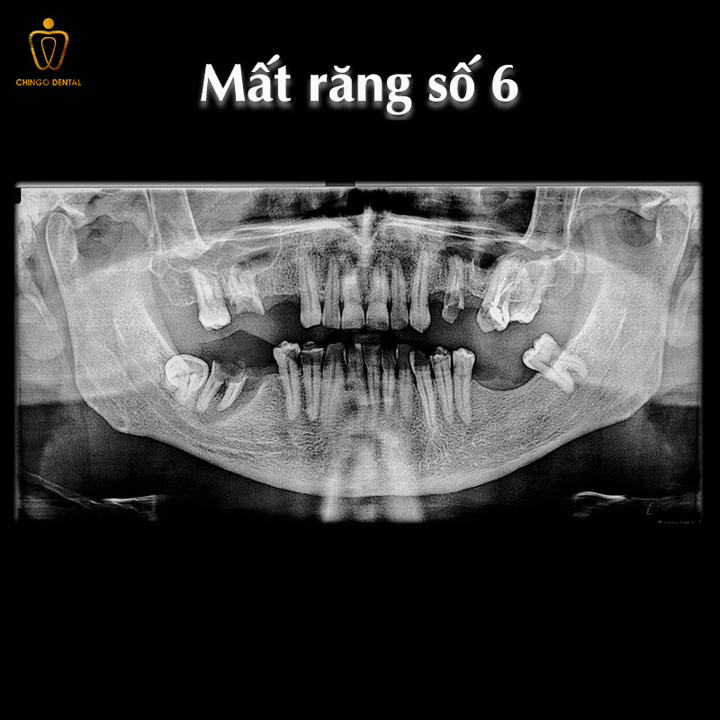 Răng Số 6 Có Thay Không? Sự Thật Về Chiếc 'Răng Cốt Lõi' Và Giải Pháp Phục Hồi Bền Vững - Cẩm Nang Sức Khỏe Cho Bạn 1 mất răng số 6 hàm dưới có sao không