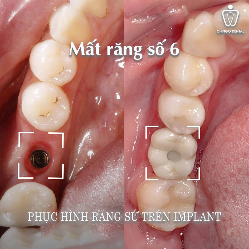 Răng Số 6 Có Thay Không? Sự Thật Về Chiếc 'Răng Cốt Lõi' Và Giải Pháp Phục Hồi Bền Vững - Cẩm Nang Sức Khỏe Cho Bạn 5 mất răng số 6
