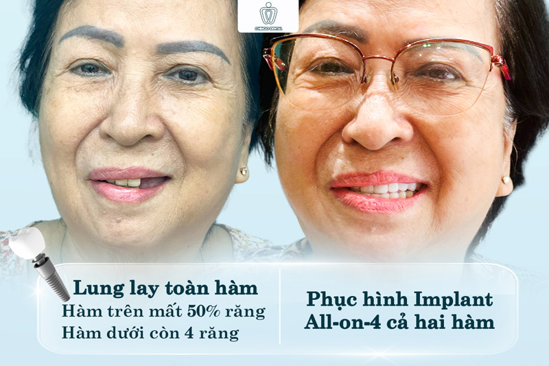 Hành Trình Cô Trinh Tìm Lại Nụ Cười Trọn Vẹn: Khi Niềm Vui Bắt Đầu Từ Những Bữa Cơm Ngon 3 mất răng